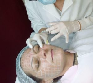 Intradermoterapia Facial